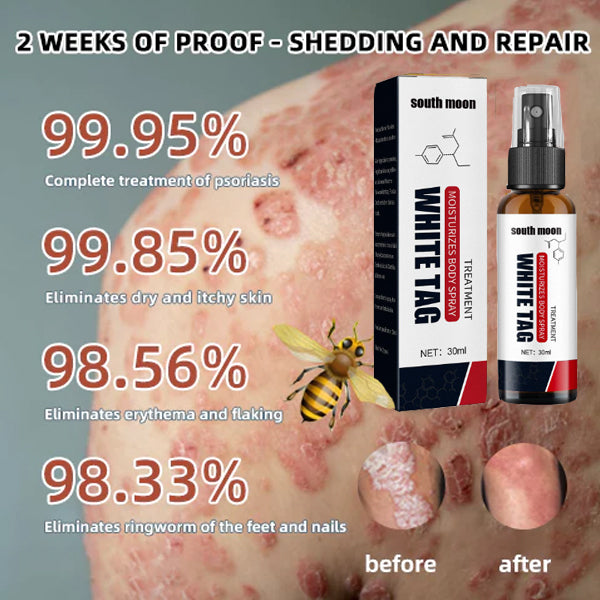 Bee Venom Psoriasis Eczema Treatment Spray (Suitable for all skin conditions)