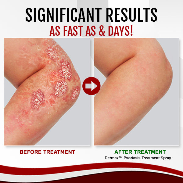 Bee Venom Psoriasis Eczema Treatment Spray (Suitable for all skin conditions)