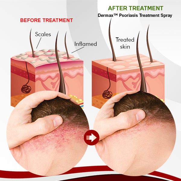 Bee Venom Psoriasis Eczema Treatment Spray (Suitable for all skin conditions)