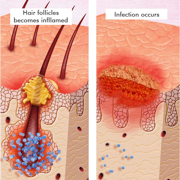 Dermax™ Folliculitis Clearing Spray