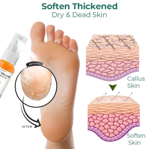 Oveallgo™ Foot Callus Removal Spray