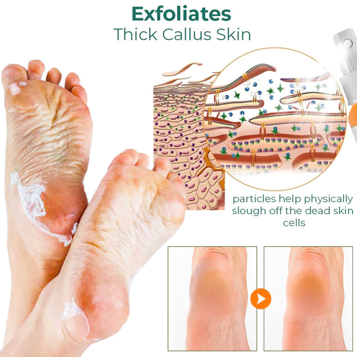 Oveallgo™ Foot Callus Removal Spray