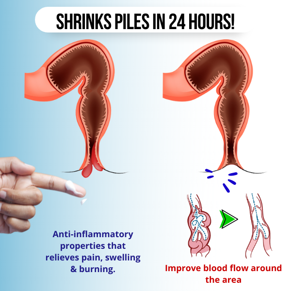 HemRelief™ Hemorrhoid & Fissure Cream