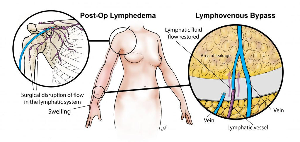 Lymphatic Drainage Therapeutic Magnetic Ring